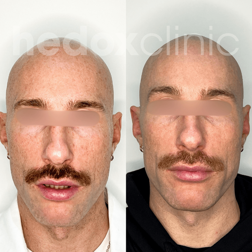 Cool Glow Laser result