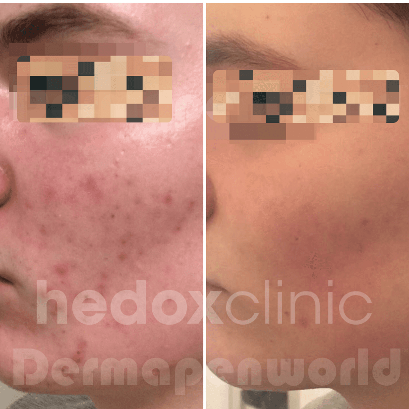 Dermapen Microneedling result