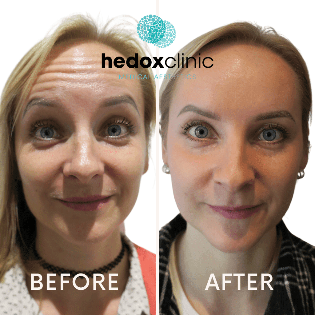 Anti-Wrinkle Treatment result